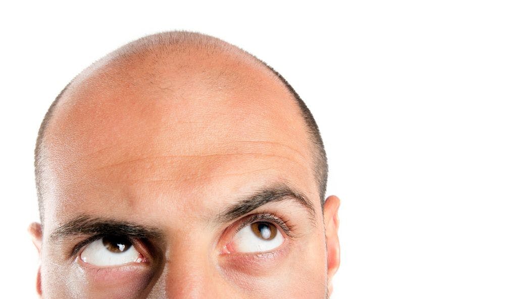 A man looking up at his balding head